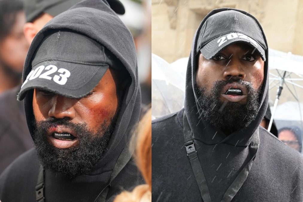 Watch: Kanye West appears with 'bloody lip & bruised face' at Paris Fashion Week