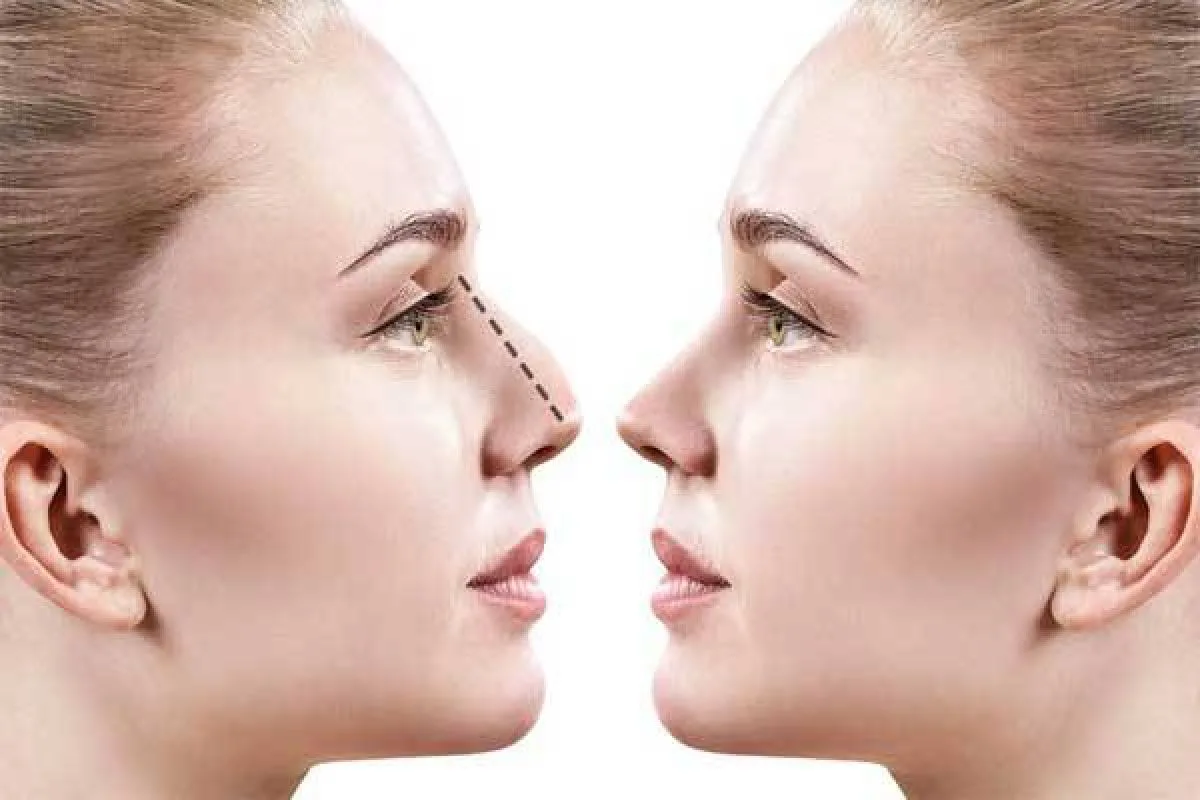 The allure of undergoing rhinoplasty