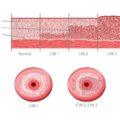 Stages of Cervical Intraepithelial Neoplasia (CIN) Development