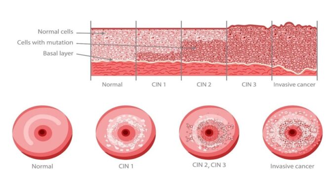 Stages of Cervical Intraepithelial Neoplasia (CIN) Development