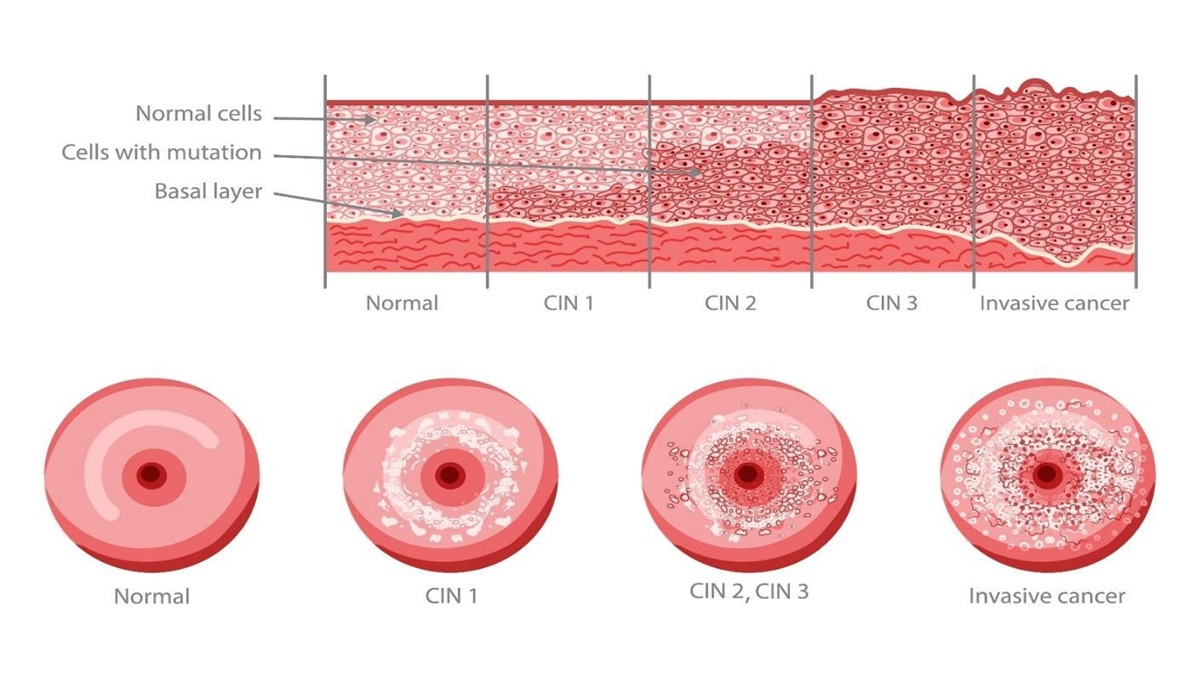 Stages of Cervical Intraepithelial Neoplasia (CIN) Development