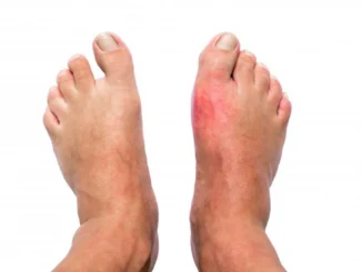 New Research Debunks Gout Myths: Blame Your DNA, Not Your Diet