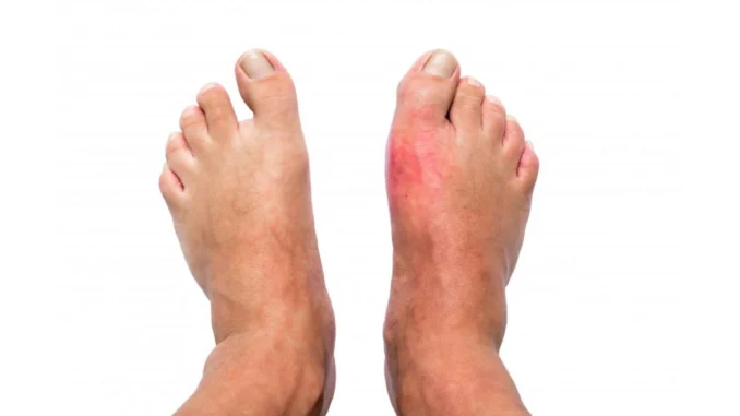 New Research Debunks Gout Myths: Blame Your DNA, Not Your Diet