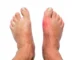 New Research Debunks Gout Myths: Blame Your DNA, Not Your Diet